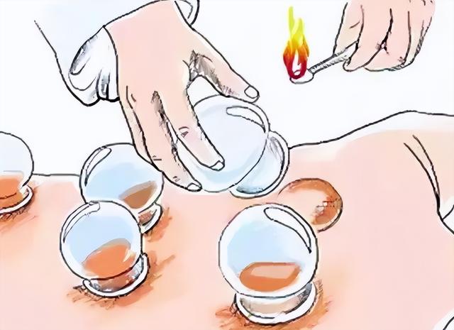 拔火罐吸出来的瘀血，是身体里的毒素吗？现在告诉你真相，看完涨知识！休闲区蓝鸢梦想 - Www.slyday.coM