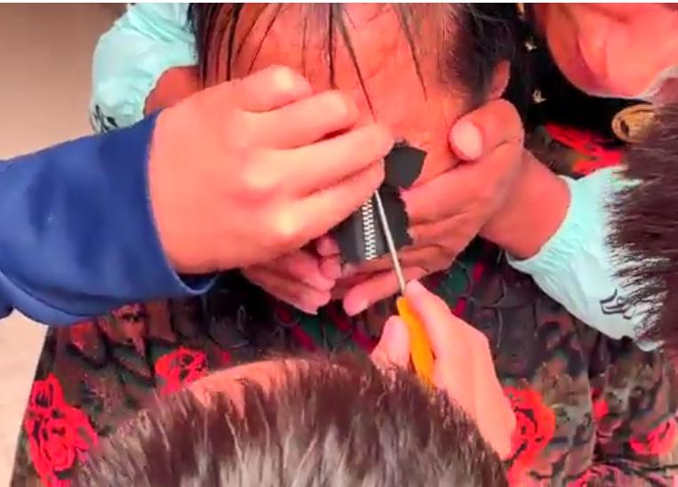 隔着屏幕都疼！浙江阿婆被拉链卡住眼皮！螺丝刀、老虎钳齐上场休闲区蓝鸢梦想 - Www.slyday.coM