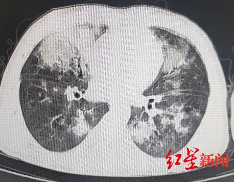 别再当“夜猫子”！长期熬夜打游戏，17岁少年多病齐发健康“大崩盘”休闲区蓝鸢梦想 - Www.slyday.coM