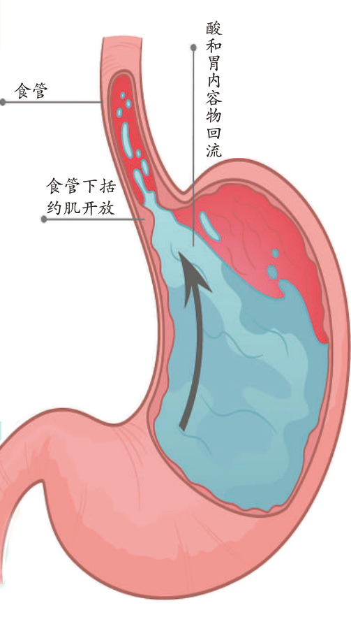 警惕极易被误诊的胃食管反流病|食管|哮喘|疾病_新浪新闻