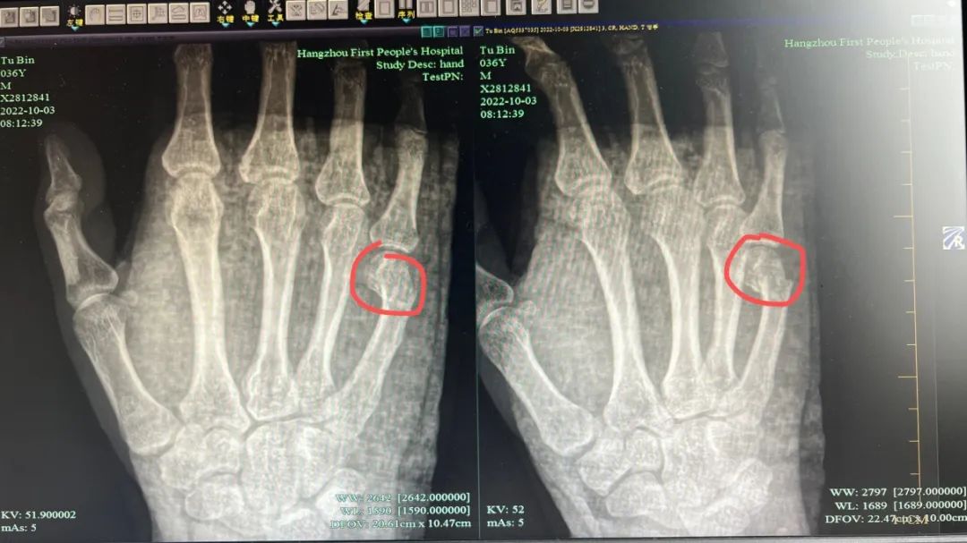 扎心！杭州爸爸辅导孩子写作业，一拳头把自己打进医院休闲区蓝鸢梦想 - Www.slyday.coM