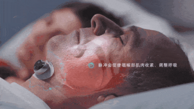 鼾症（OSAHS阻塞性睡眠呼吸暂停低通气综合征）的治疗休闲区蓝鸢梦想 - Www.slyday.coM