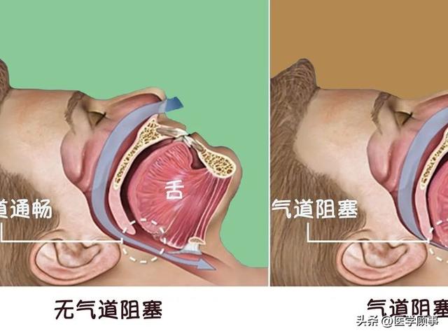 鼾症（OSAHS阻塞性睡眠呼吸暂停低通气综合征）的治疗休闲区蓝鸢梦想 - Www.slyday.coM
