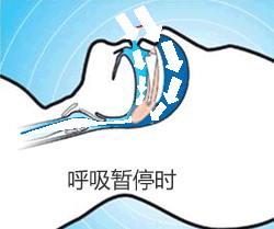 鼾症（OSAHS阻塞性睡眠呼吸暂停低通气综合征）的治疗休闲区蓝鸢梦想 - Www.slyday.coM