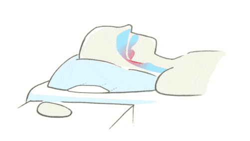 鼾症（OSAHS阻塞性睡眠呼吸暂停低通气综合征）的治疗休闲区蓝鸢梦想 - Www.slyday.coM