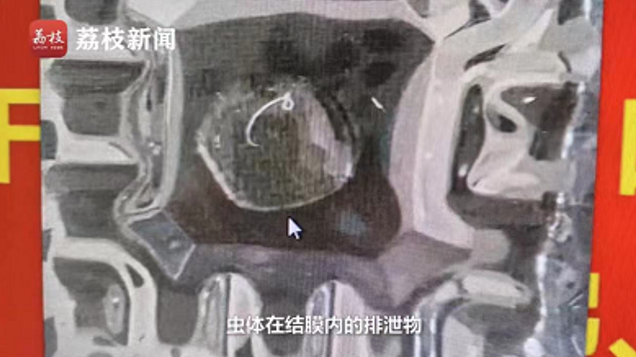 姑娘眼睛里有条2厘米的线虫！原因疑似“撸”狗后没洗手休闲区蓝鸢梦想 - Www.slyday.coM