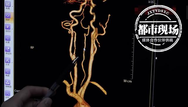 顿顿吃肉！67岁大叔血管里堵了一块4厘米长的黄色“油脂”休闲区蓝鸢梦想 - Www.slyday.coM