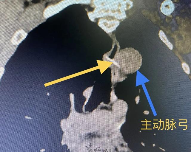 鱼刺离人体最大的动脉只差1mm，专家临危不惧拔除“胸头刺”|食道|异物|食管_新浪新闻