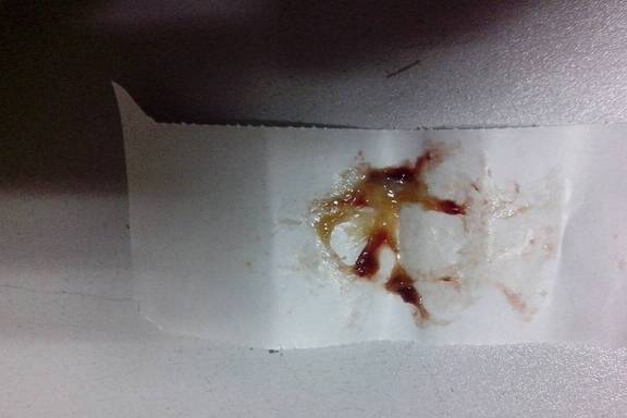 黄痰是热,白痰是寒?医生提示:若咳出4类痰,或是肺部受损了__财经头条