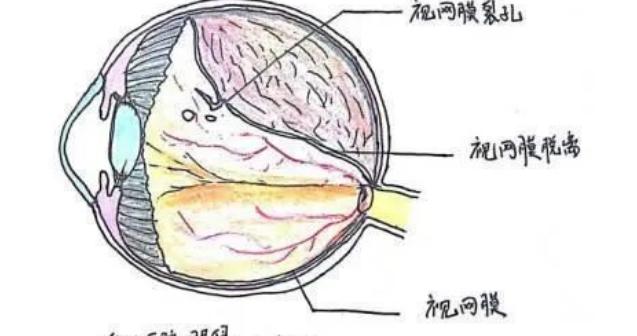 突然眼闪光,飞蚊绕,视力突然下降,你可能患有视网膜问题了|视网膜|视力_新浪新闻