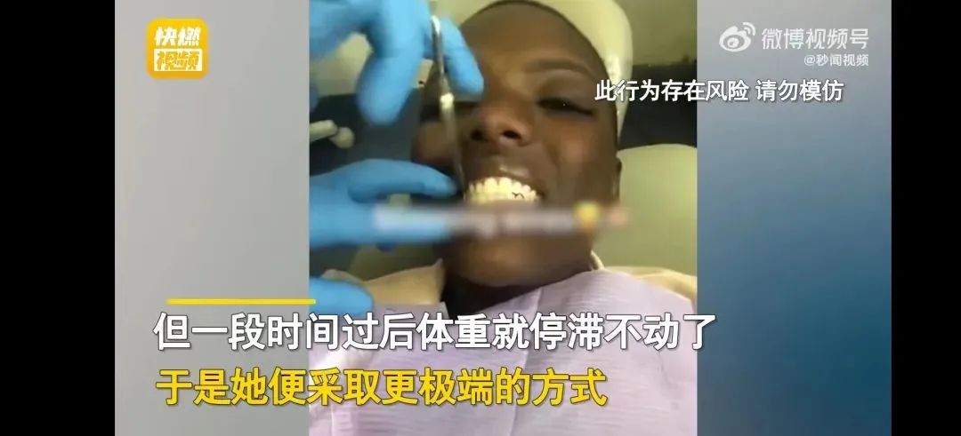 女子绑牙“绝食”49天，瘦身28斤走红网络：减肥的底层逻辑是什么？-绑牙齿的好处与坏处