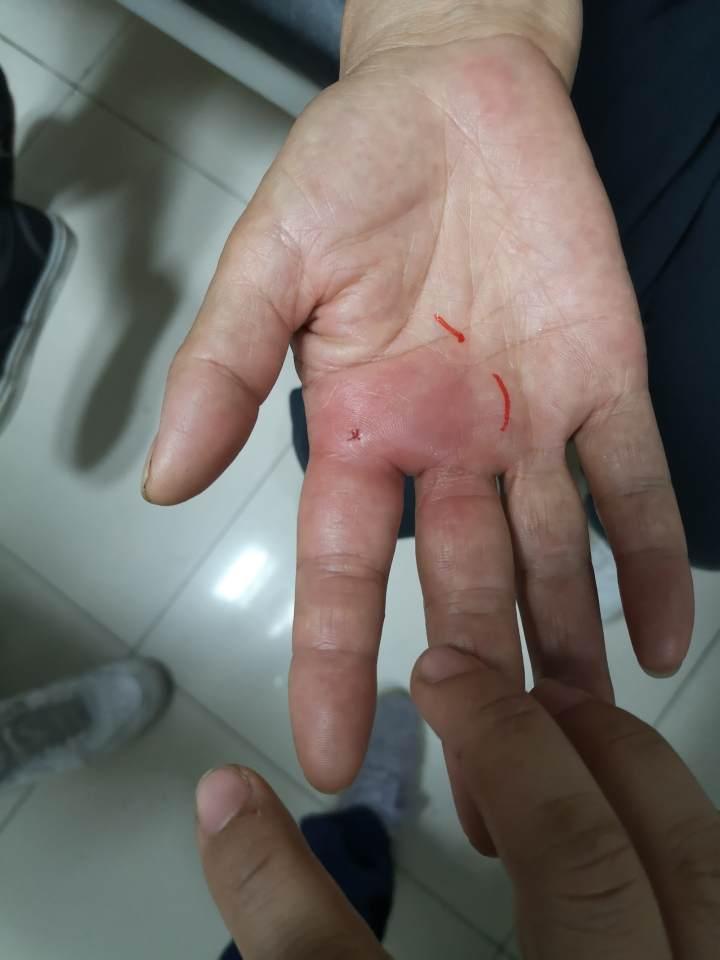 小时健康小站最前线丨被鱼扎了下,整个手掌都肿了!