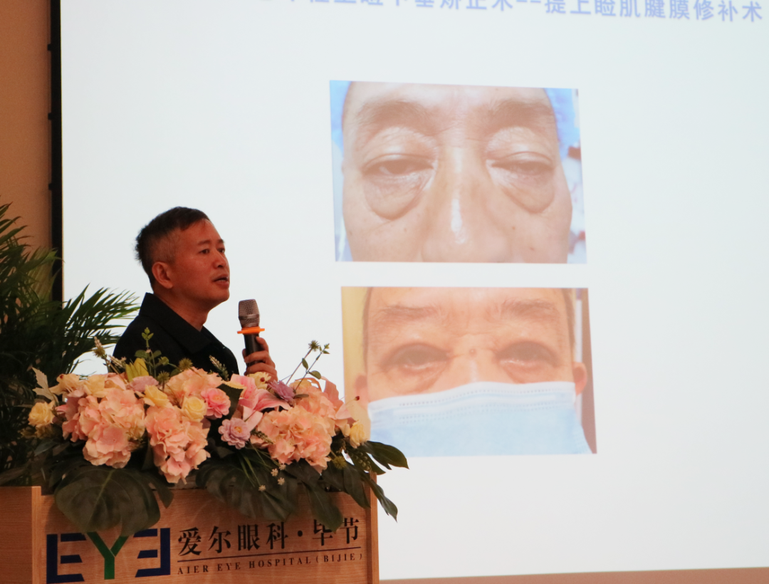 副主任医师,黔西南爱尔眼科医院院长刘忠华分享《眼整形疾病诊疗》