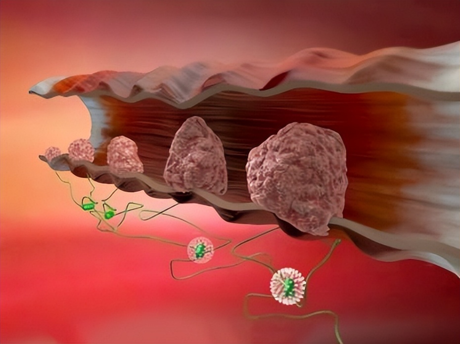 大便若出现3种异常,需警惕是癌症来临|癌症|便秘|大便_新浪新闻