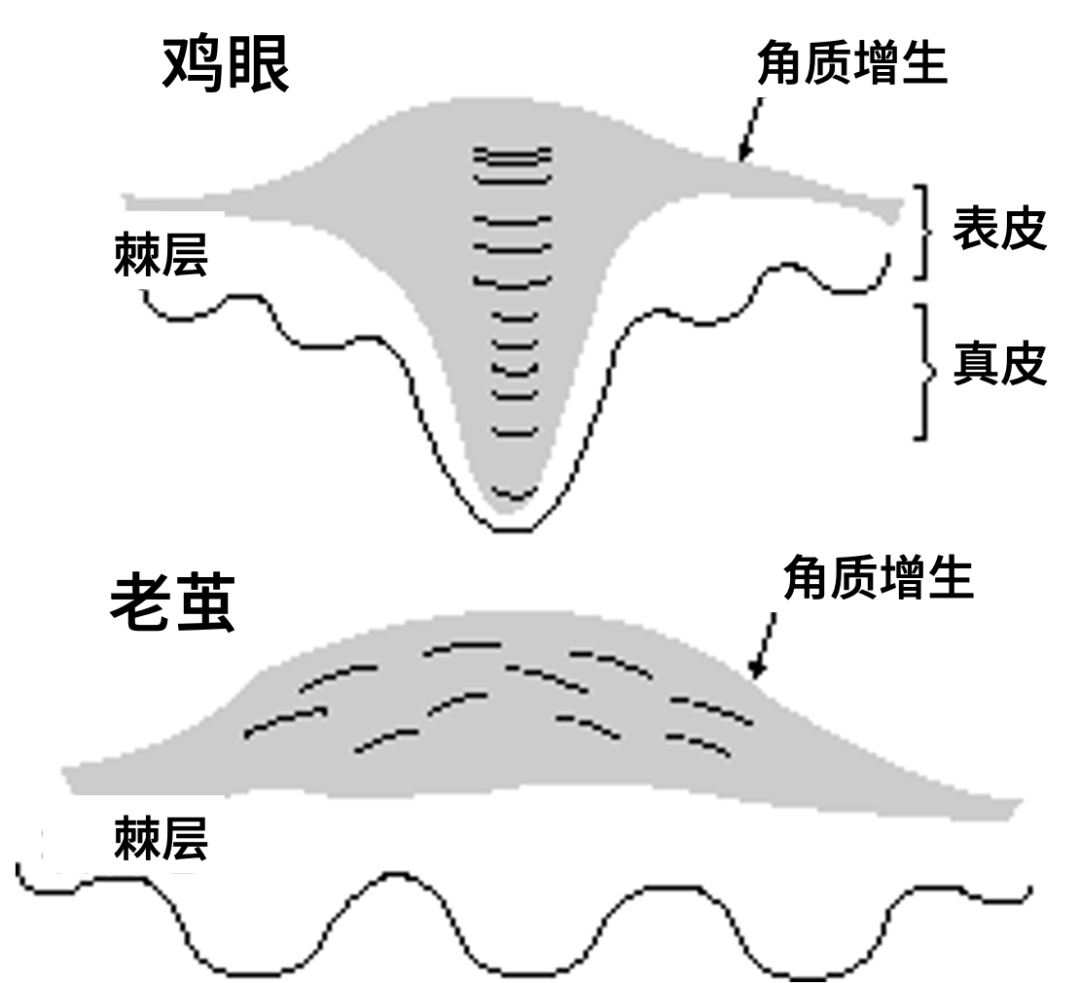 老茧和鸡眼的区别 图：参考文章（有改动）