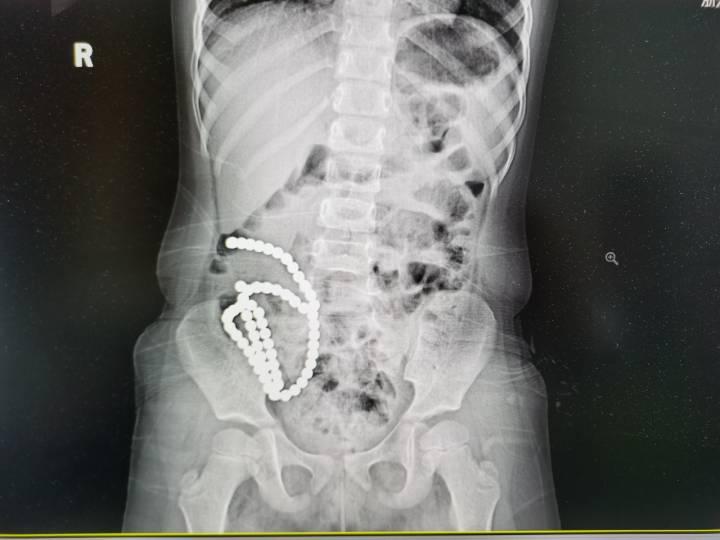 女童误食61颗磁力珠导致14处肠穿孔，医生呼吁家长不要买这种玩具！休闲区蓝鸢梦想 - Www.slyday.coM