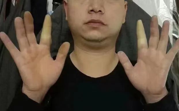 ▲胡运良展示双手食指遇冷变白症状。 受访人供图