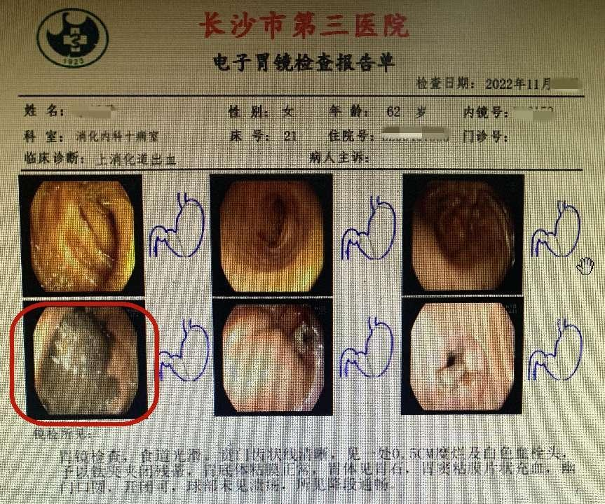 电子胃镜报告单.图源:长沙市第三医院