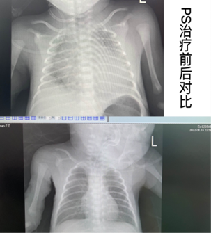 早期早产儿出生后管理核心是它们！拯救早产儿呼吸管理是重要的一关！| 新生儿病例解析及专家点评|早产儿|新生儿|新生儿呼吸窘迫综合征_新浪新闻