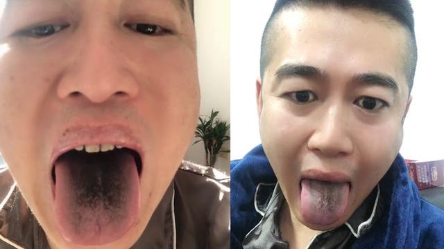 隔天舌头上的颜色变浅了,除了退烧了,其他症状都还有,神经一阵阵的