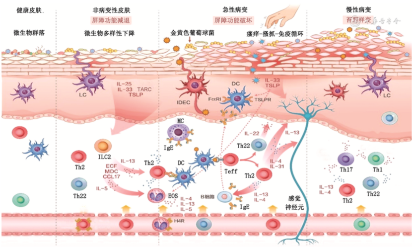 新格局下的新方向,首次多学科合力解密!全球首个2型炎症性疾病多学科专家共识发布,阐明机制、指导诊疗丨奇点深度