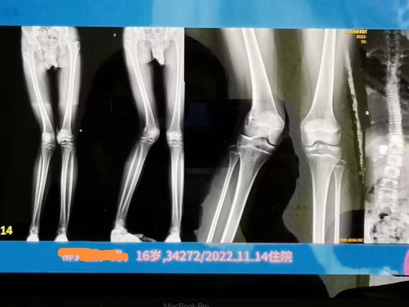 成功为一名16岁男孩矫正右腿k型和短缩畸形