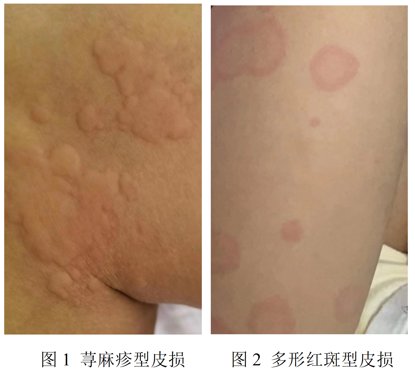 科普|新冠病毒感染,可能会带来哪些皮肤损害?