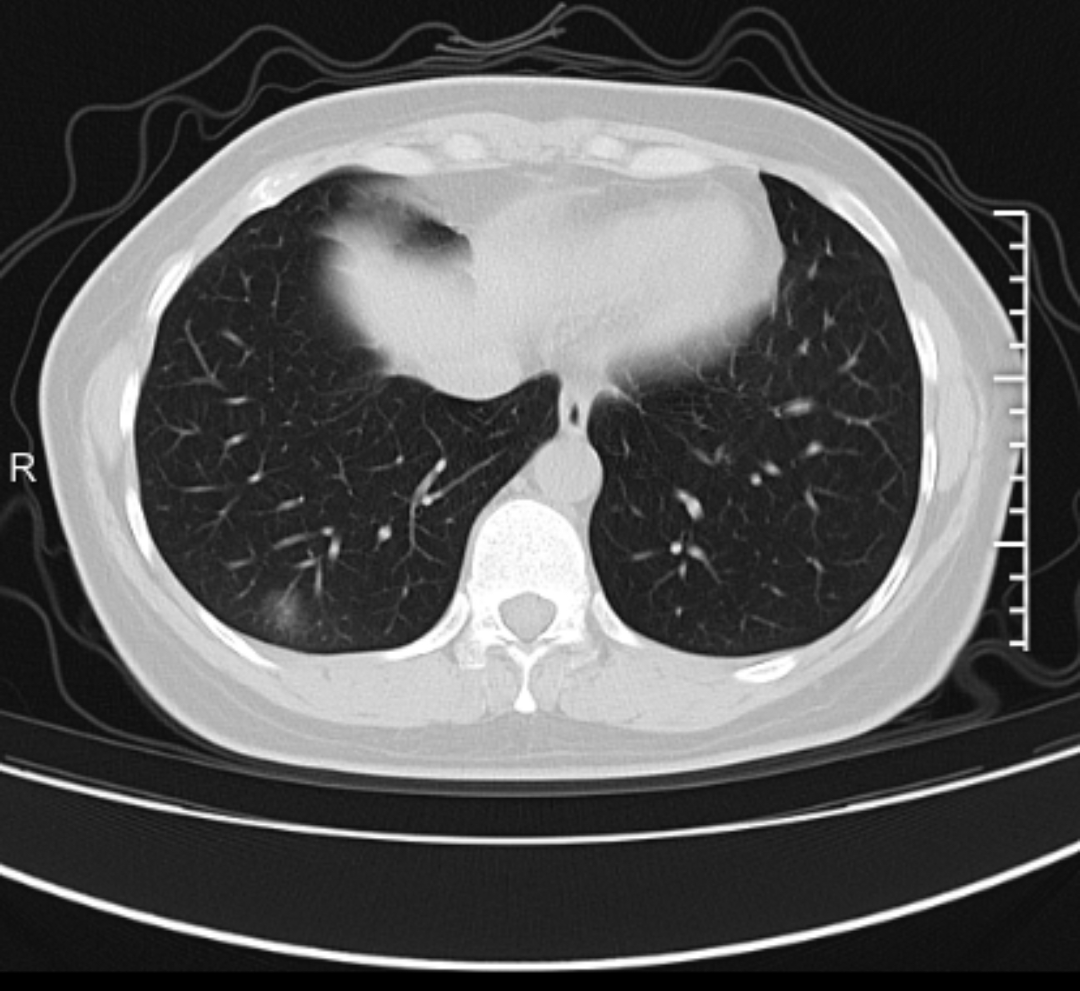 新冠肺炎的肺图片图片