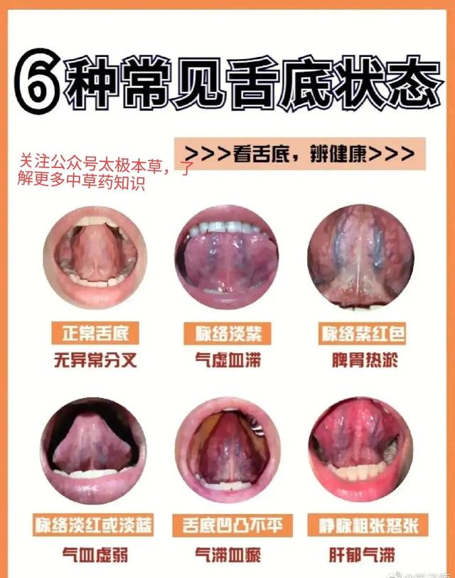照镜子,看看舌下有青筋吗?|青筋|静脉|舌头_新浪新闻