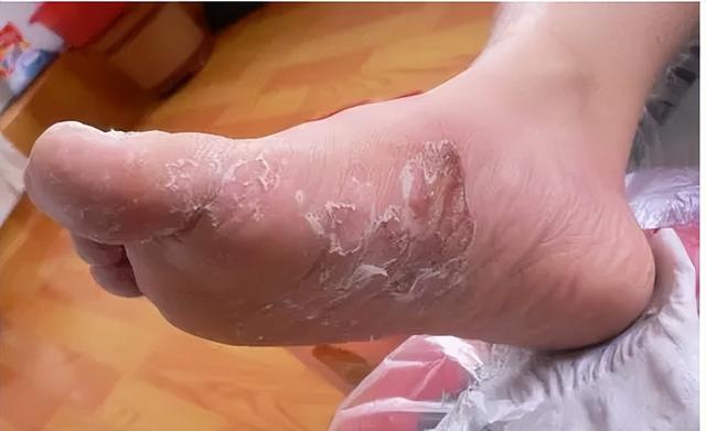 足癣为真菌感染引起的皮肤病,典型症状有:成都中医药大学副研究员蒲