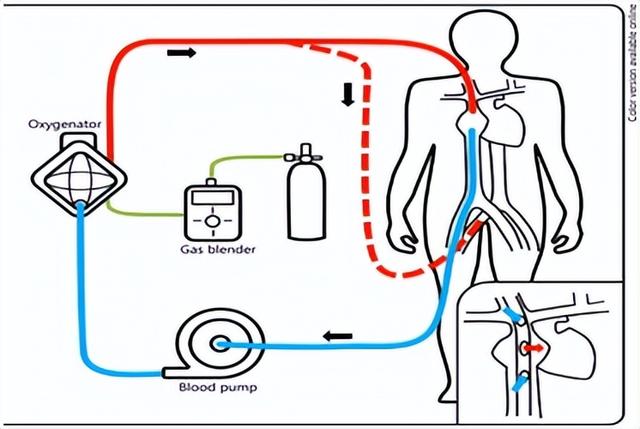 ecmo全称是体外膜肺氧合,简单讲就是"人工心脏"和"人工肺"的结合.