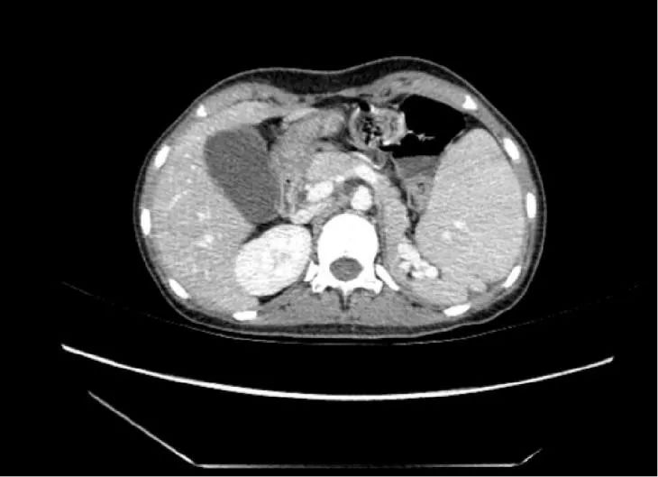 图2&nbsp; 术前ct显示脾脏增大&nbsp