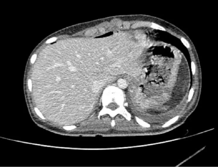 门静脉压力为12cmh2o(压力正常),造影显示肝内外门静脉均正常(图4)