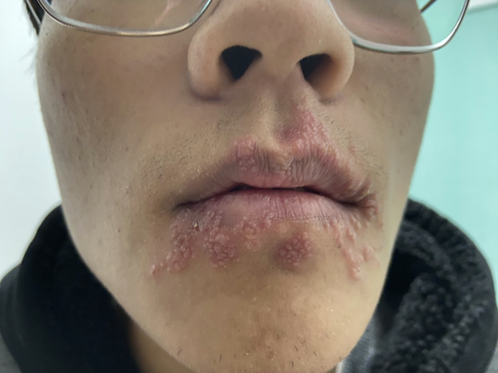 新冠感染后口周单纯疱疹