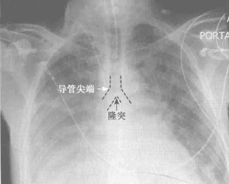 ICU常用导管位置,图文并茂,一文读懂|导管|气管|隆突_新浪新闻