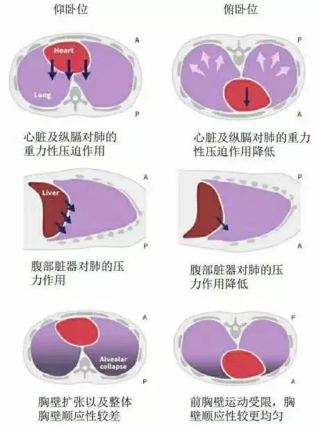 新冠科普丨认识俯卧位通气,应趴尽趴__财经头条