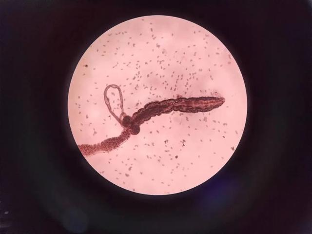 杭州9岁男孩总说痒,上厕所竟发现很多白色的……|蛲虫_新浪财经_新浪