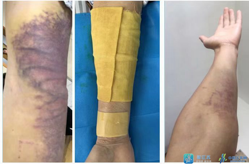 红丹散瘀油不仅适用于心血管介入术后及各类穿刺部位皮下血肿的消散