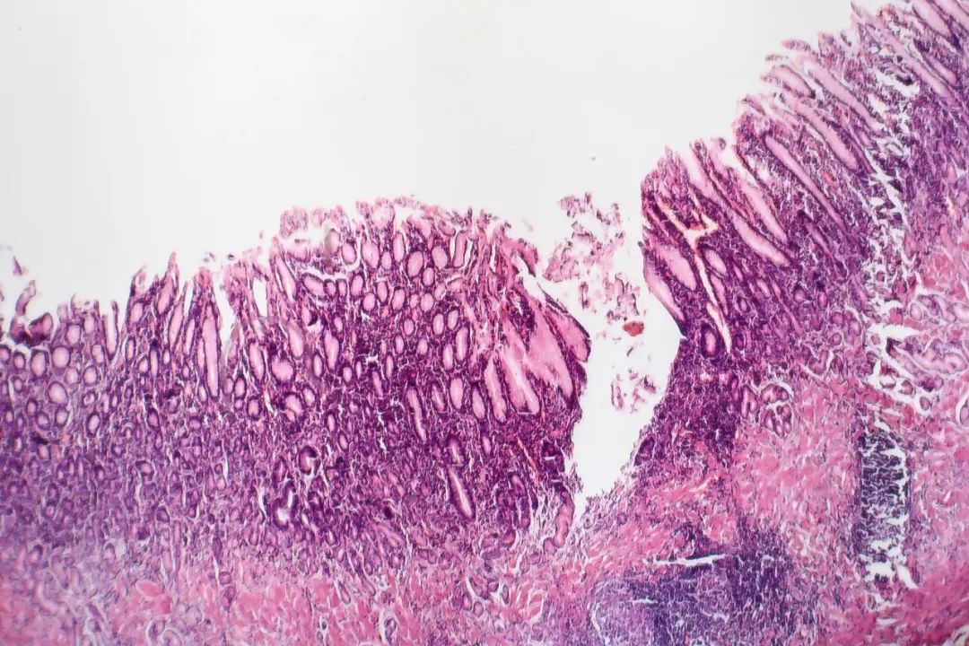 这6种常见病,其实都是"癌前病变"!|癌症_新浪财经_新浪网