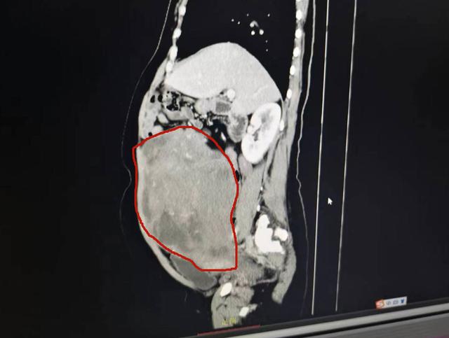 女子肚大如孕妇,手术取出5公斤重子宫肌瘤|手术_新浪财经_新浪网