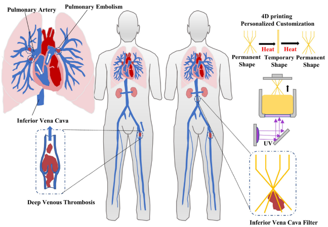 4D打印形状记忆IVCF微创治疗PE的设计示意图。