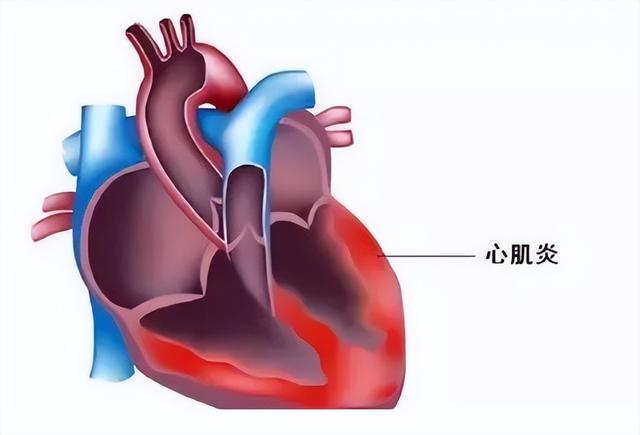新冠后,心肌炎是成“重点”之一,记住这些中医疗法,有用!