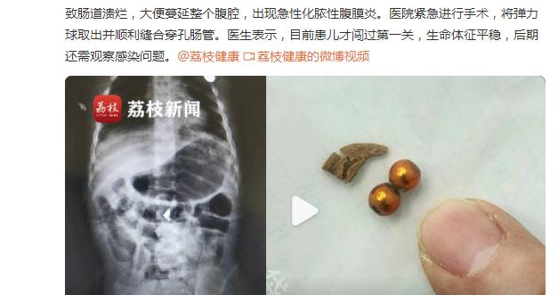 1岁宝宝误吞弹力球致肠道溃烂，大便蔓延整个腹腔……