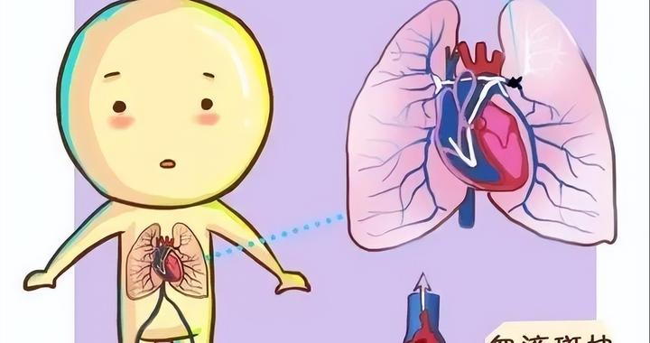 八旬老人反复咳嗽咳痰气促，背后的“隐形杀手”竟是广泛性肺栓塞|肺栓塞|广泛性|肺动脉_新浪新闻