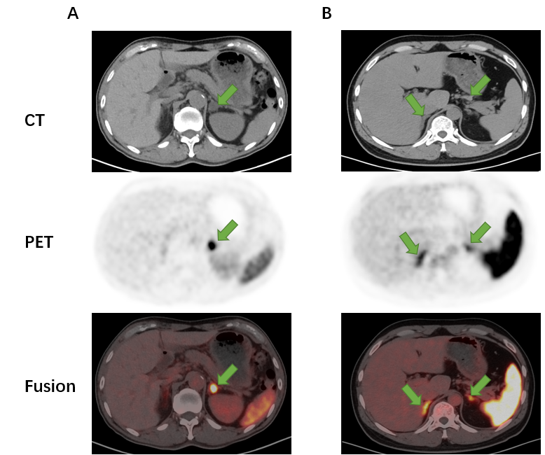 ct(68镓-cxc趋化因子受体4 pet/ct显像)对原发性醛固酮增多症(简称"原
