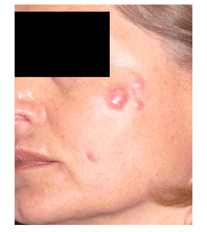 注射后的红斑结节.图片来自参考文献[7]