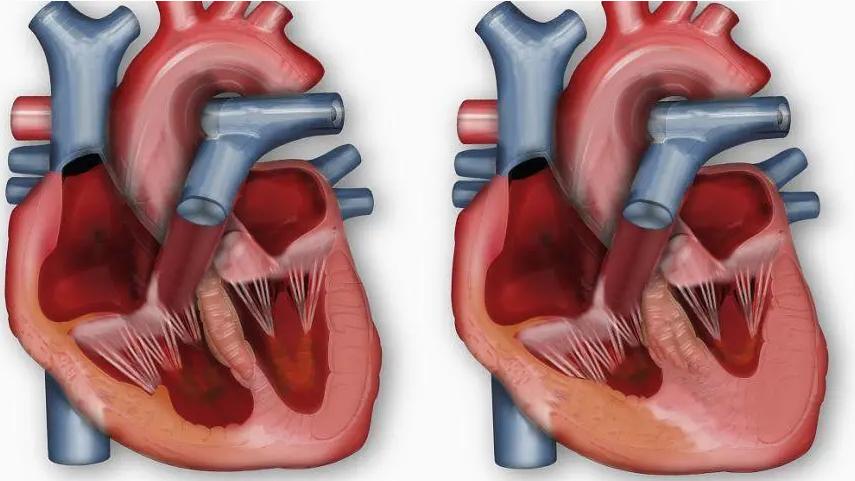 二尖瓣狭窄能活多久