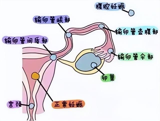 宫外孕手术报销政策 生育津贴领取条件