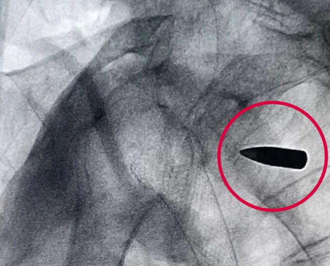 CT拍出来，医生们都吓了一跳！