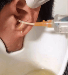 如使用额镜或耳内镜看清耳道内情况,小心用镊子或耵聍钩将耳屎取出